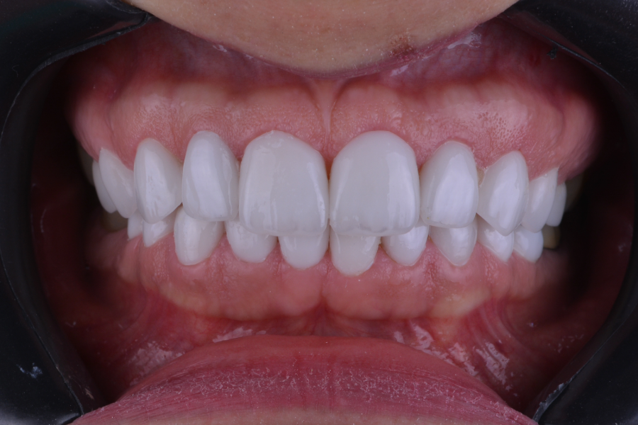 بعد تغير لون و شكل الأسنان لإعادة تأهيل الابتسامة.